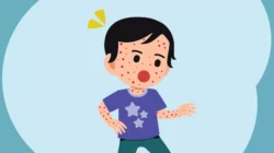 Makassar hingga Luwu Timur Masuk Daftar Daerah Terdampak KLB Campak