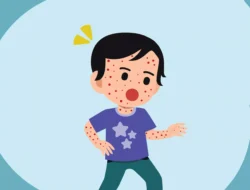 Makassar hingga Luwu Timur Masuk Daftar Daerah Terdampak KLB Campak